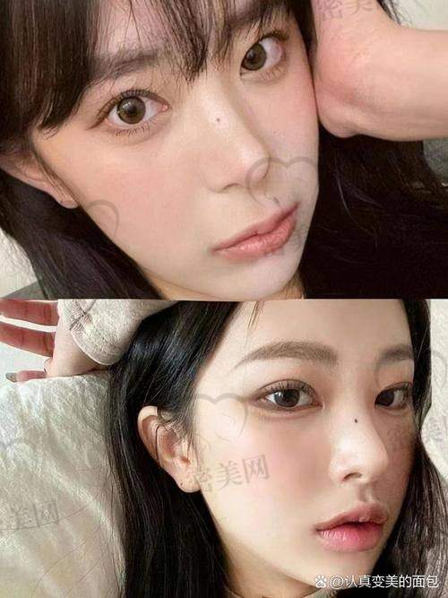 王皓民人中塑形技术的优势总结