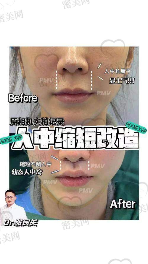 为何人中缩短是“天选项目”？适合哪些脸型？——王皓民分析建议