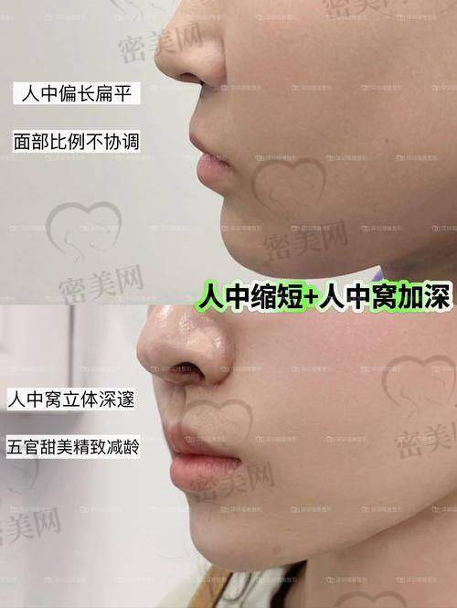 王皓民特色人中脊+人中凹塑形技术解析
