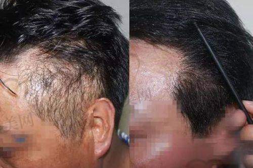 杭州大麦微针植发正规吗？有正规资质吗？