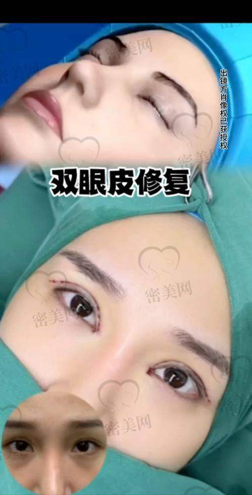 西宁美莱医学美容医院——王磊医生的眼部魔法