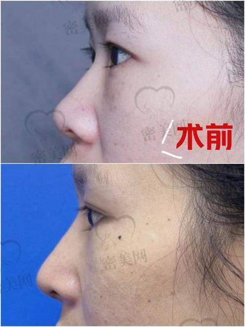 上海艺星许炎龙肋软骨隆鼻：真人实例大赏