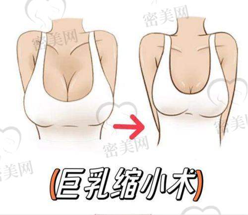 广州荔湾整形外科医院：经典乳晕切口缩胸术还有人做！