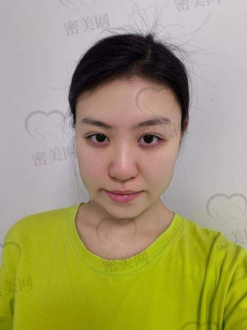 黄大勇操刀 Bodytite 手术：优势特色大曝光