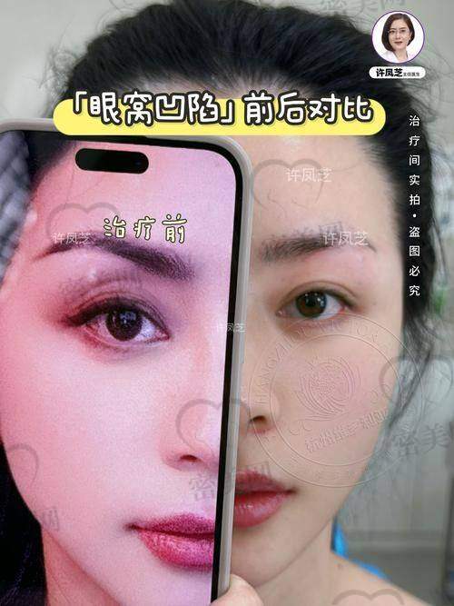 注射玻尿酸的危害要知道
