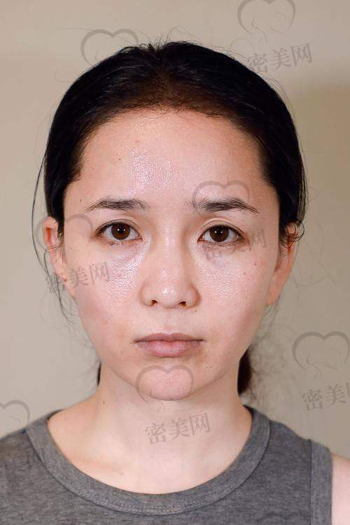 注射玻尿酸的维持时间有多久