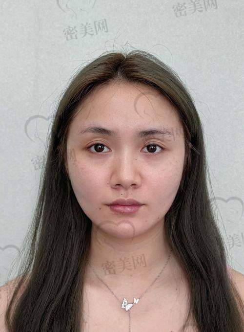 注射玻尿酸的常见项目