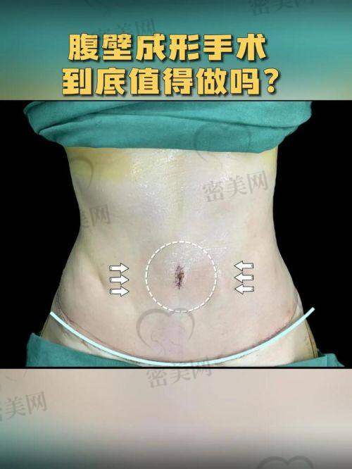 北京夏扬整形外科工作室——小腹重塑“魔术师”