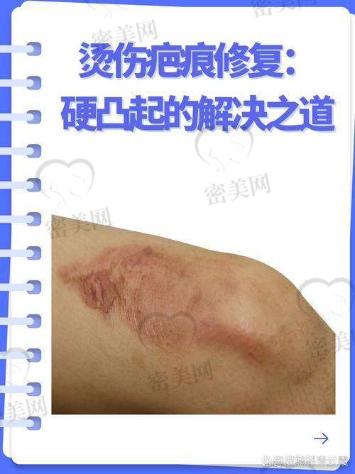 池凯医生治疗疤痕的真实实例反馈：多数患者满意