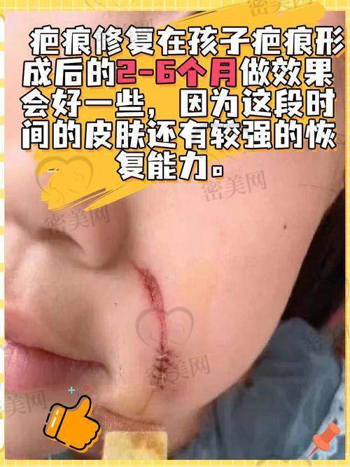 池凯医生治疗疤痕技术解析：为什么他和别人不一样？