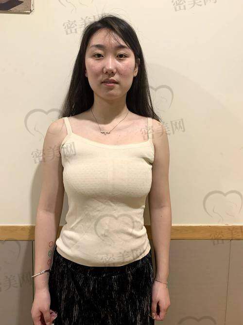 注射玻尿酸丰胸的注意事项