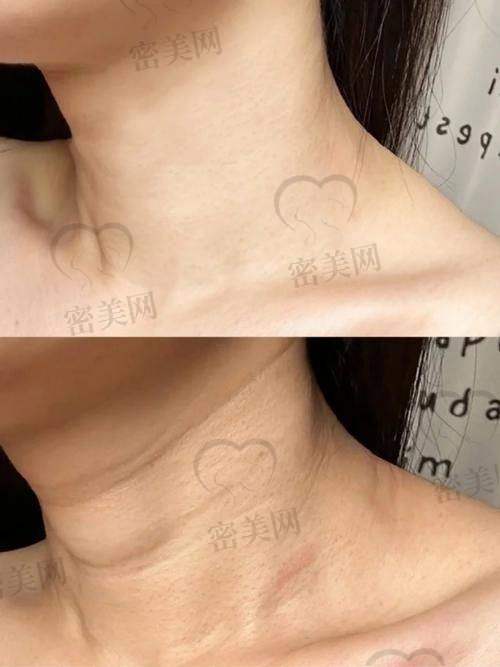 嗨体去颈纹，多久打一次？