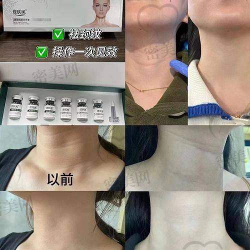 嗨体去颈纹，有啥风险和注意事项？