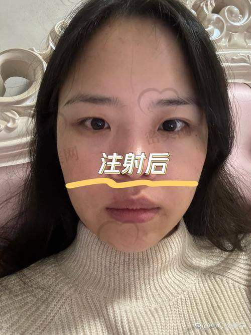 玻尿酸额头去皱多少钱呢？
