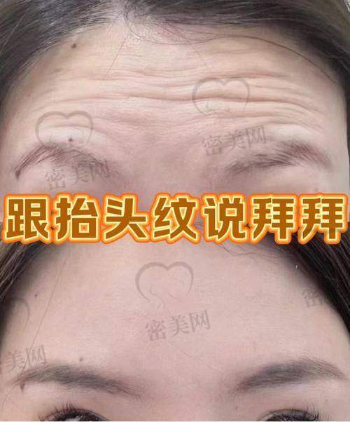 还有哪些去额纹的方法？