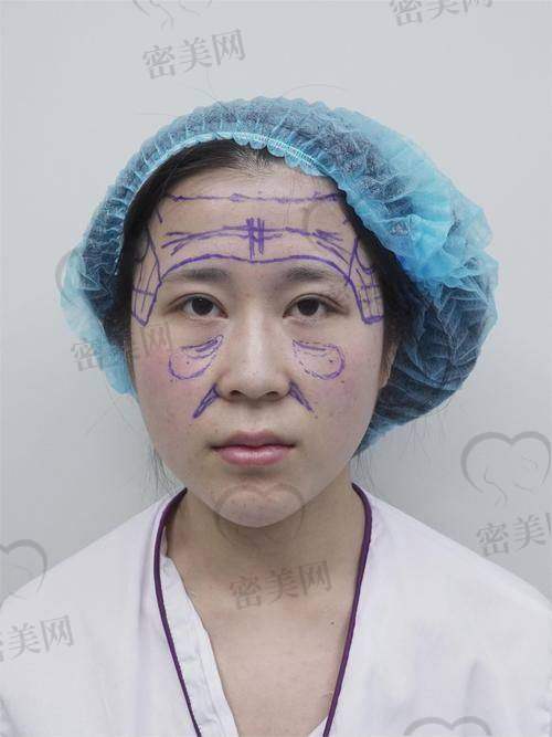 打玻尿酸能维持多久