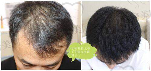 杭州大麦微针植发项目范围广吗？基础服务怎么样？