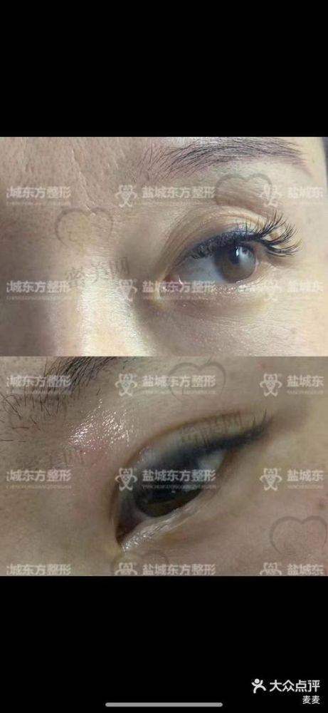 填充眼窝凹陷的失败实例要警惕
