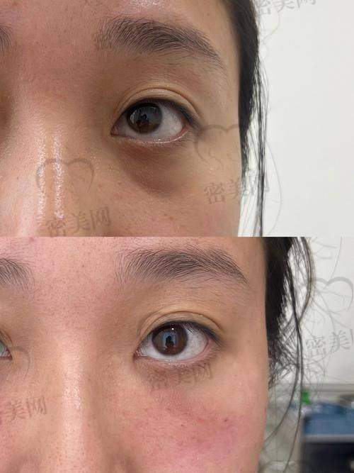 填充眼窝凹陷的修复周期