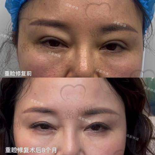 北京晶美医疗美容魏志香：内眼角修复的“成功见证者”