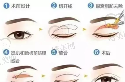 刘剑医生技术特点：