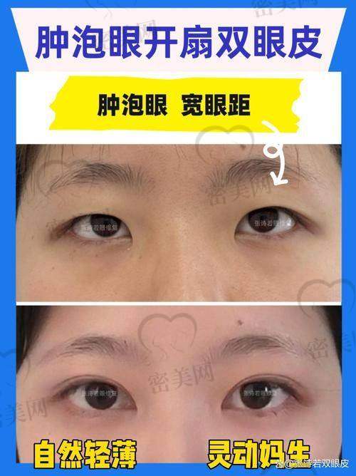 上海许炎龙口碑怎么样？双眼皮手术实例超惊艳
