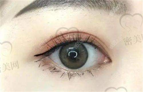 上海伯思立整形周珍艳双眼皮：技术优势大揭秘