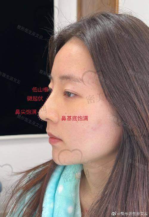 上海伯思立整形沈国雄：真人实例的惊艳成效