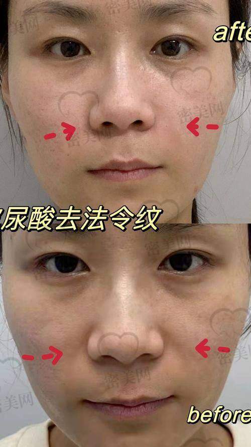 韩国整形实例：看看别人的“逆袭之路”