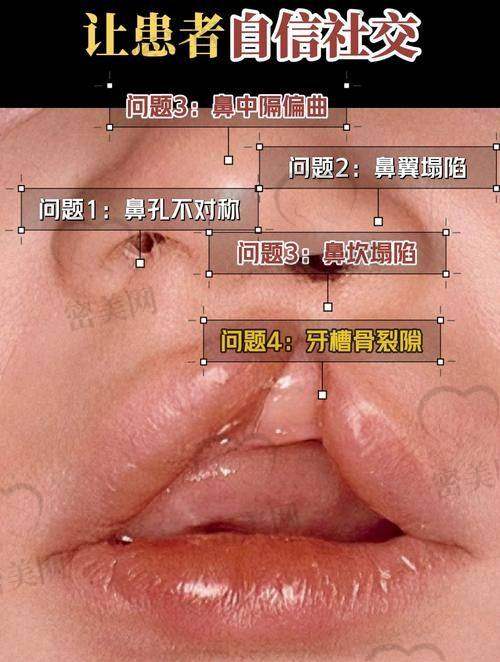 为什么这么多患者选择找余文林做唇裂修复？