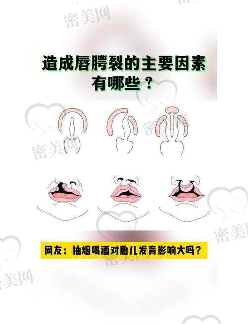 余文林医生唇裂修复技术到底有多厉害？