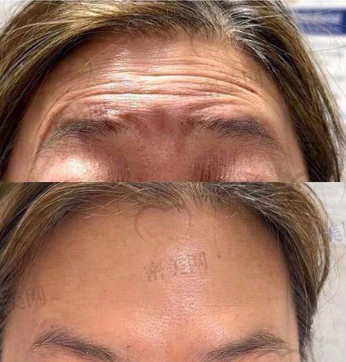 去除抬头纹的其他攻略