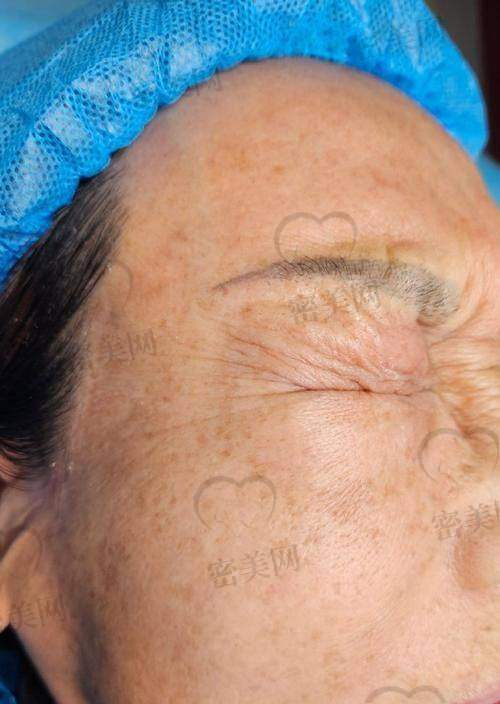 不同年龄段适合的去抬头纹整形项目