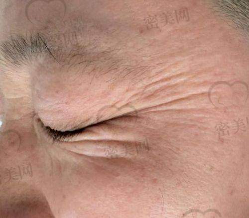 热门医美产品助力去除抬头纹