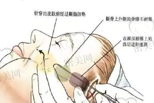 海璐医生技术特点：