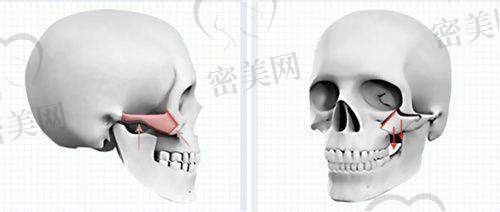 东莞壹加壹整形医院吸脂塑形项目费用一览
