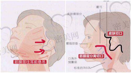 郭凯医生技术特点：