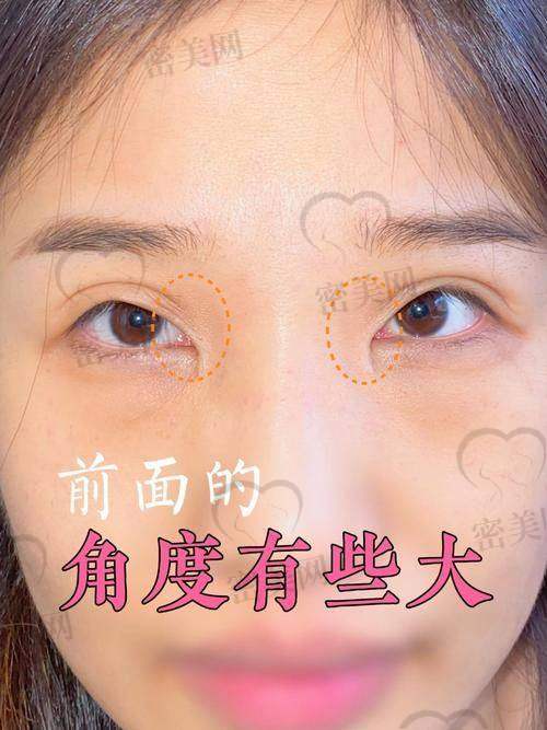 第二部分：2025年备受关注的双眼皮修复医生深度解析