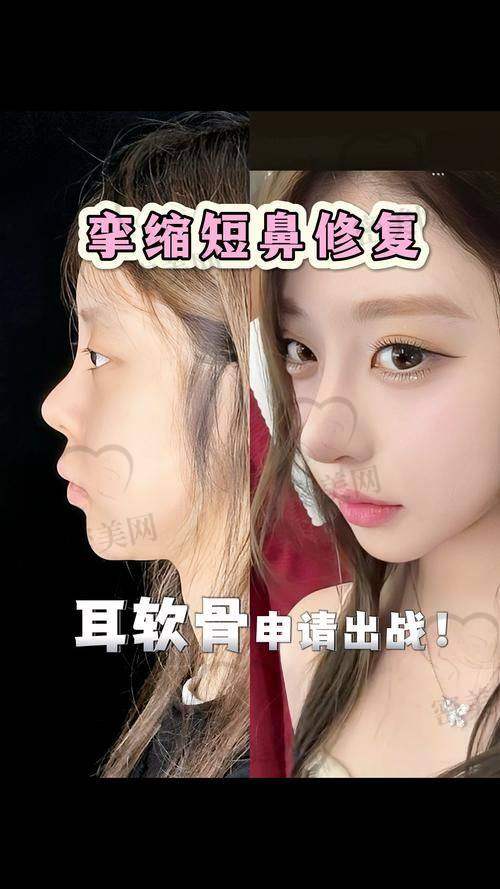 上海伯思立整形徐文龙鼻修复：真人实例大分享