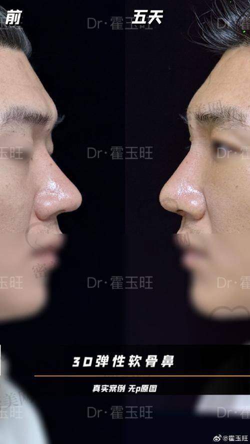 上海伯思立整形徐文龙鼻修复：价格大揭秘