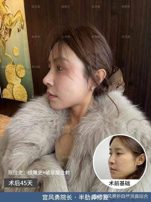 北京沃尔医院冯雁平鼻修复：口碑爆棚的秘密武器