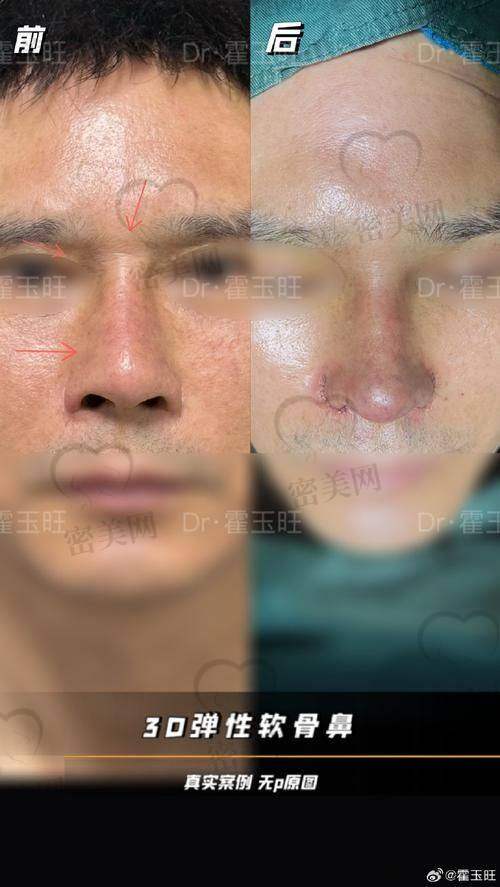 北京沃尔医院冯雁平鼻修复：不错技术优势大揭秘