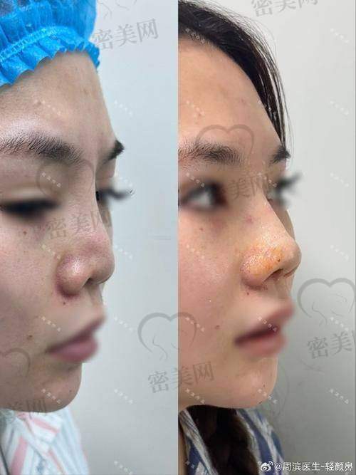 上海伯思立整形：鼻修复项目的强大后盾