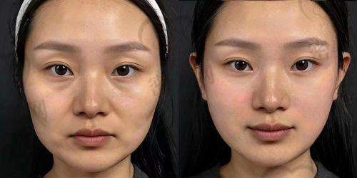 面部填充整形有啥危害？