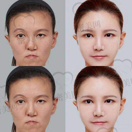 面部填充整形成效能维持多久？