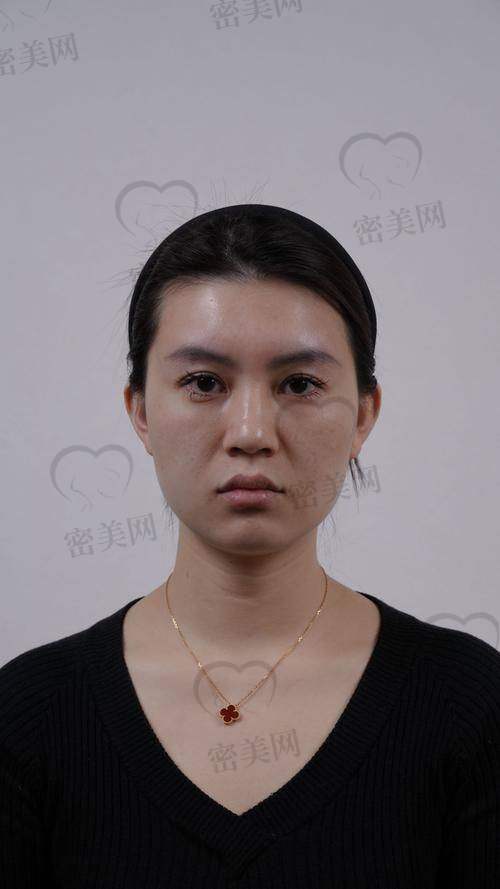 打针玻尿酸有啥副作用和功效？
