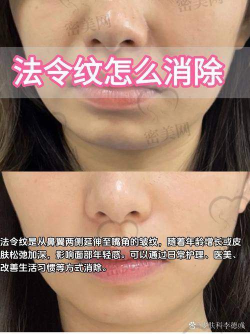 童颜针填充法令纹能维持多久？