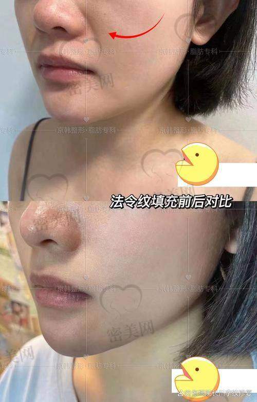 注射填充法令纹有啥副作用