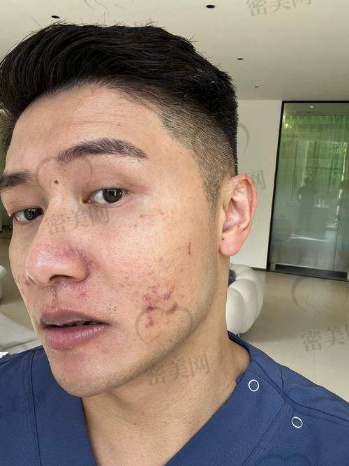 玻尿酸填充痘坑有啥风险和注意事项呢？