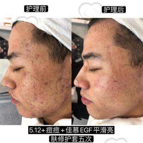 玻尿酸填充痘坑要填充几次呢？
